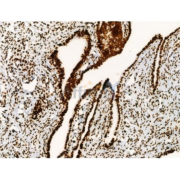 Acetyl-Histone H2A (Lys5) Antibody - AF4354 at 1/100 staining Human ovarian cancer by IHC-P.