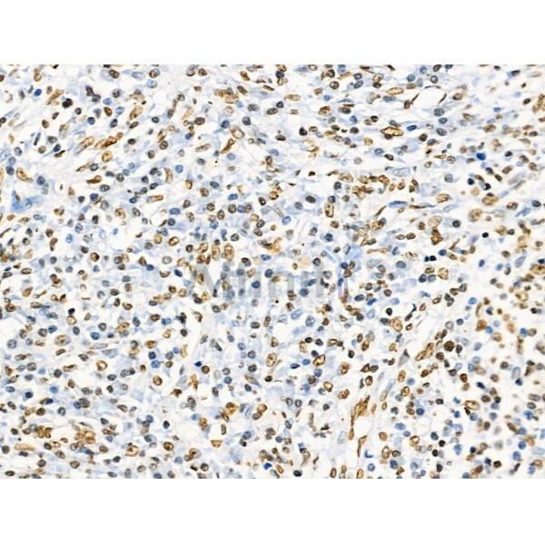 Acetyl-Histone H2A (Lys5) Antibody - AF4354 at 1/100 staining Human liver cancer and adjacent normal tissues by IHC-P.