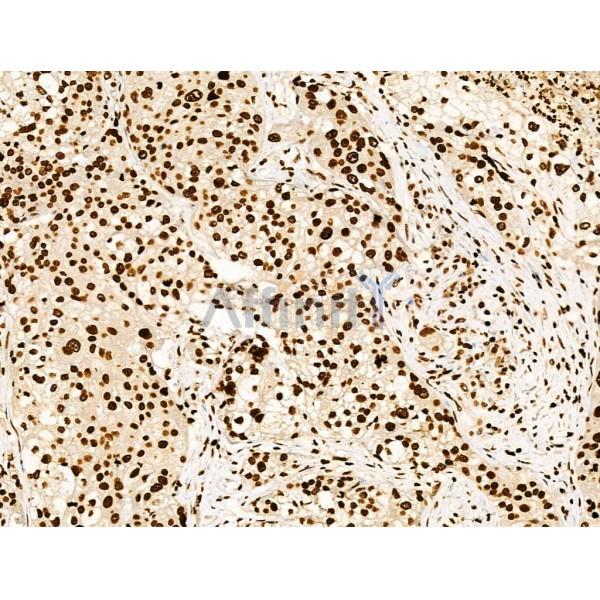 Acetyl-Histone H4 (Lys91) Antibody - AF4357 at 1/100 staining Human pancreatic cancer by IHC-P.