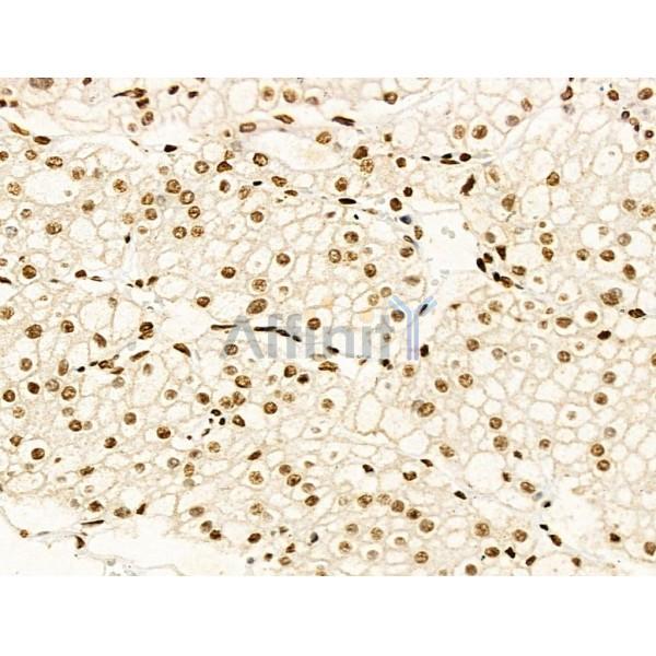 Acetyl-Histone H4 (Lys91) Antibody - AF4357 at 1/100 staining Human kidney cancer by IHC-P.