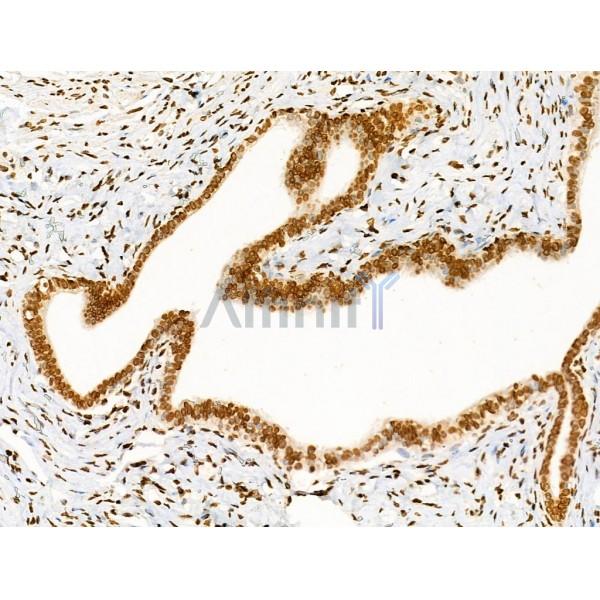 Acetyl-Histone H4 (Lys91) Antibody - AF4357 at 1/100 staining Human ovarian cancer by IHC-P.
