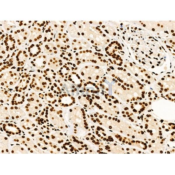 Acetyl-Histone H4 (Lys91) Antibody - AF4357 at 1/100 staining Human kidney cancer by IHC-P.