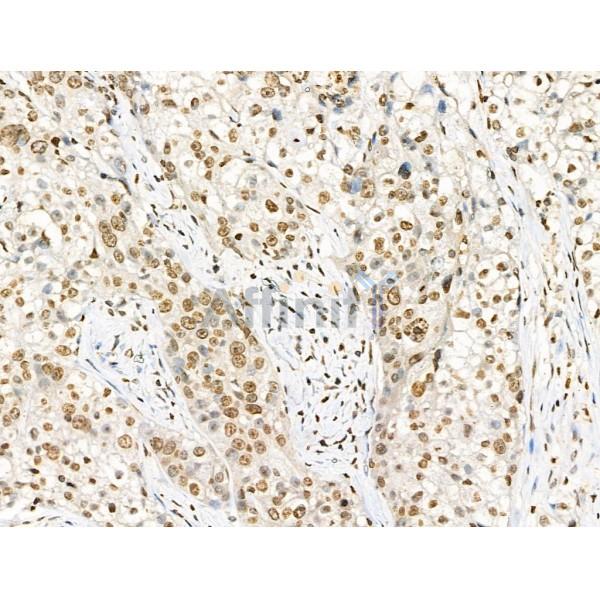 Phospho-Histone H4 (Tyr89) Antibody - AF4358 at 1/100 staining Human pancreatic cancer by IHC-P.
