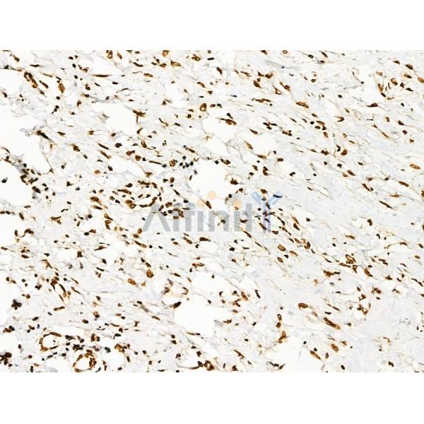 Acetyl-p53 (Lys373) Antibody - AF4363 at 1/100 staining Human esophageal cancer by IHC-P.
