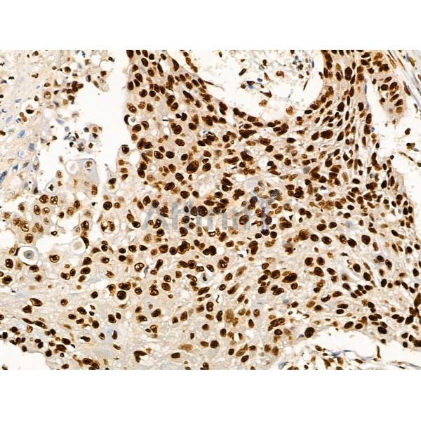 Acetyl-p53 (Lys373) Antibody - AF4363 at 1/100 staining Human esophageal cancer by IHC-P.