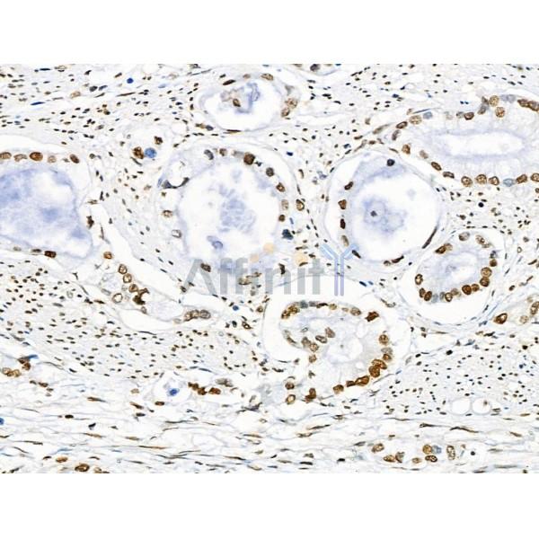 Acetyl-p53 (Lys373) Antibody - AF4363 at 1/100 staining Human gastric cancer by IHC-P.