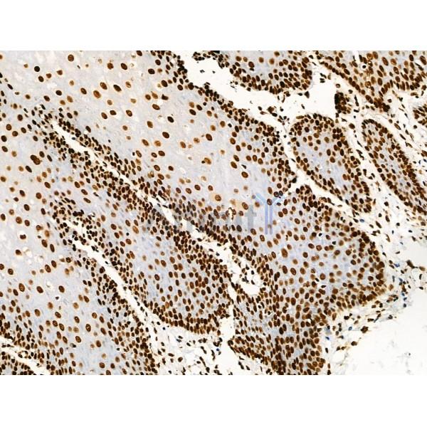 Acetyl-p53 (Lys373) Antibody - AF4363 at 1/100 staining Human esophageal cancer and adjacent normal tissues by IHC-P.