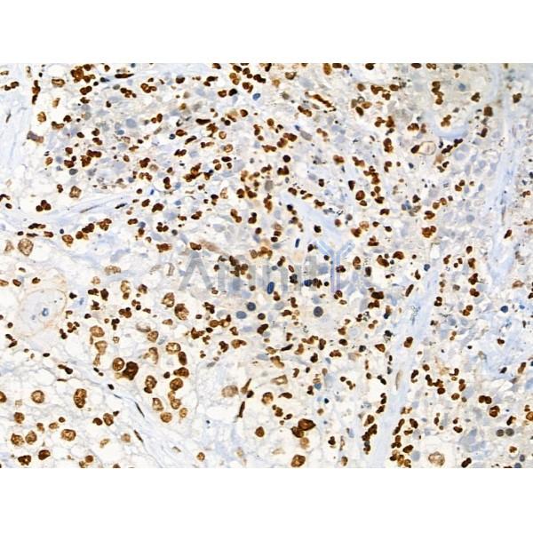 Acetyl-p53 (Lys373) Antibody - AF4363 at 1/100 staining Human pancreatic cancer by IHC-P.