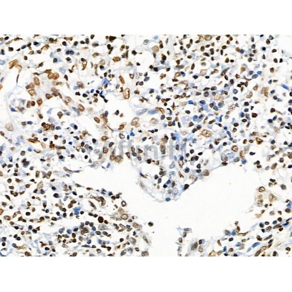 Acetyl-p53 (Lys373) Antibody - AF4363 at 1/100 staining Human lung cancer by IHC-P.
