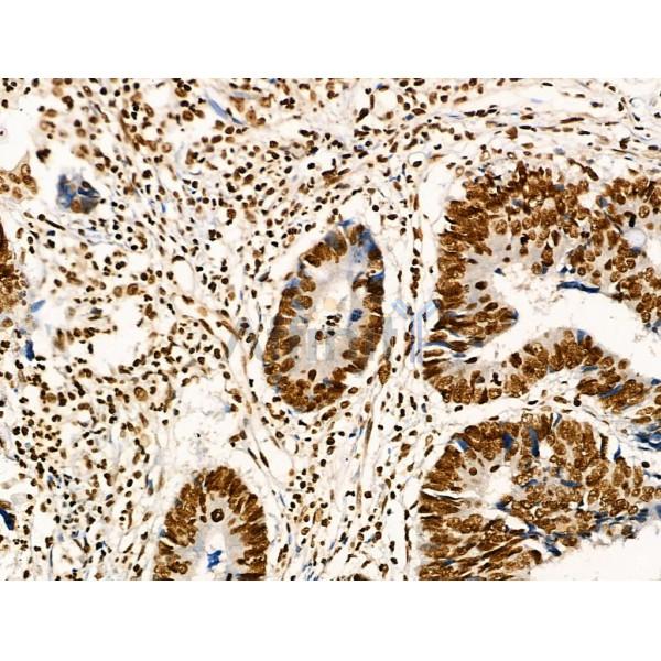Acetyl-p53 (Lys373) Antibody - AF4363 at 1/100 staining Human colorectal cancer by IHC-P.