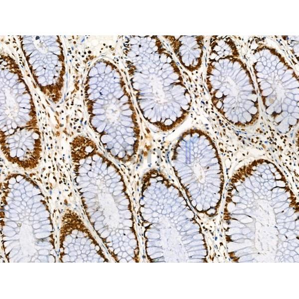 Acetyl-p53 (Lys373) Antibody - AF4363 at 1/100 staining Human colorectal cancer by IHC-P.
