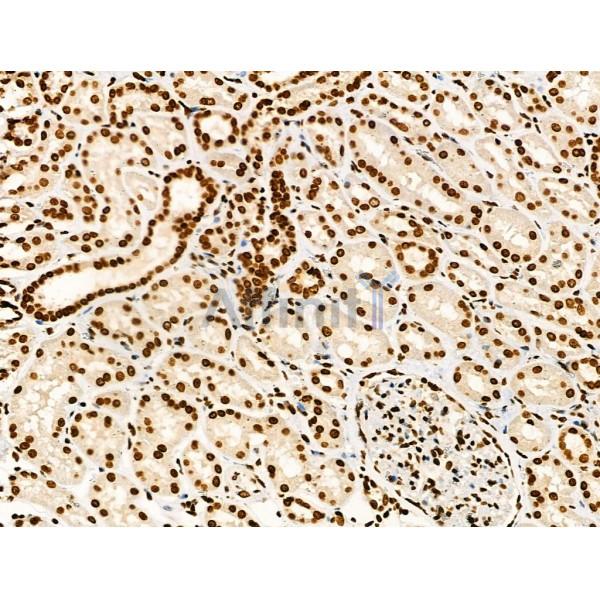 Acetyl-p53 (Lys373) Antibody - AF4363 at 1/100 staining Human kidney cancer by IHC-P.