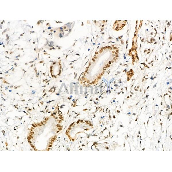 Acetyl-p53 (Lys373) Antibody - AF4363 at 1/100 staining Human pancreatic cancer by IHC-P.