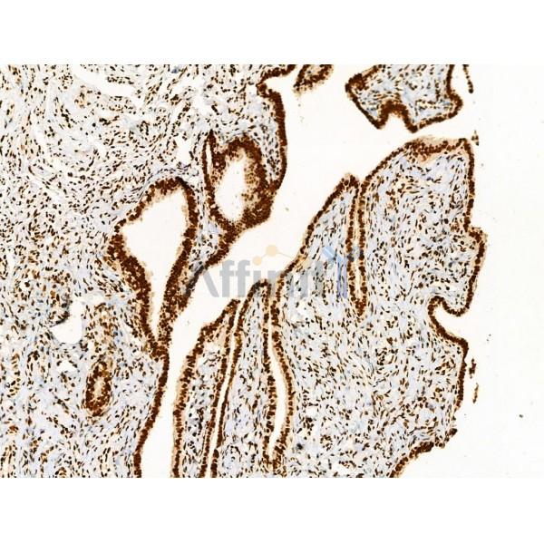 Acetyl-p53 (Lys373) Antibody - AF4363 at 1/100 staining Human ovarian cancer by IHC-P.