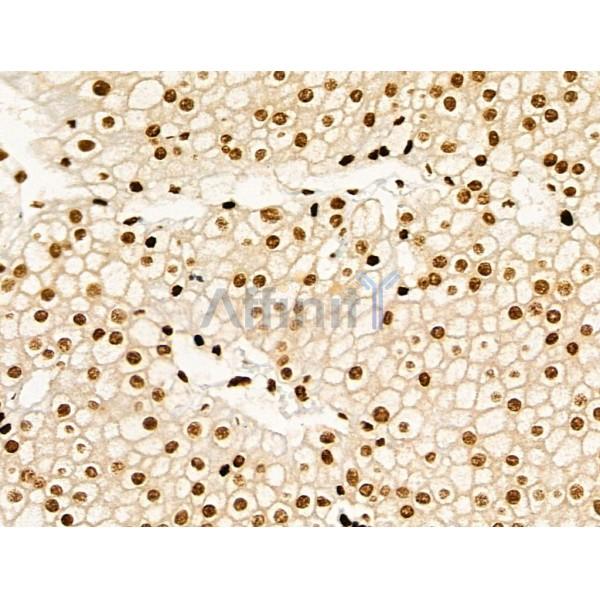 Acetyl-p53 (Lys373) Antibody - AF4363 at 1/100 staining Human kidney cancer by IHC-P.