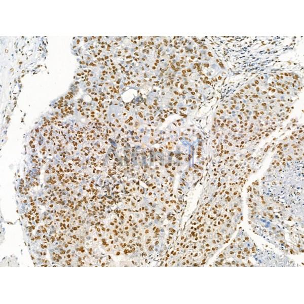 Acetyl-p53 (Lys373) Antibody - AF4363 at 1/100 staining Human liver cancer by IHC-P.