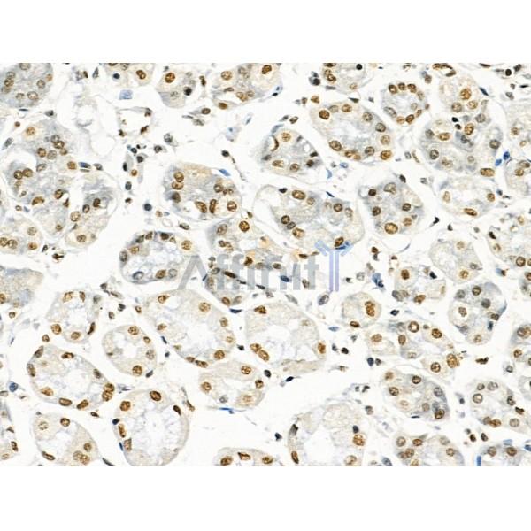 Acetyl-H2A.Z (Lys4/7/11/13) Antibody - AF4366 at 1/100 staining Human gastric cancer and adjacent normal tissues by IHC-P.
