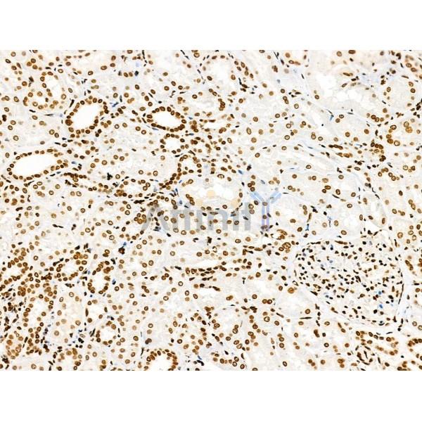 Acetyl-H2A.Z (Lys4/7/11/13) Antibody - AF4366 at 1/100 staining Human kidney cancer by IHC-P.