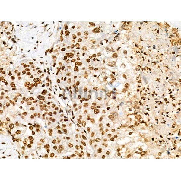 Acetyl-H2A.Z (Lys4/7/11/13) Antibody - AF4366 at 1/100 staining Human pancreatic cancer by IHC-P.