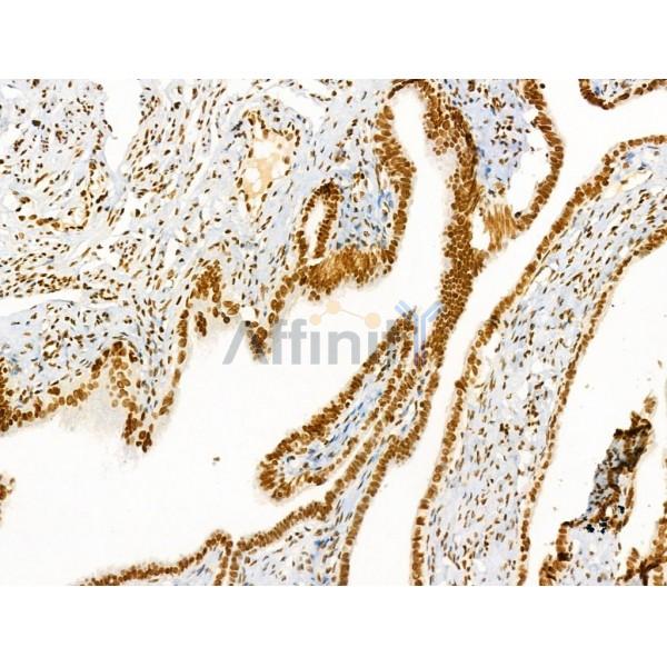 Acetyl-H2A.Z (Lys4/7/11/13) Antibody - AF4366 at 1/100 staining Human ovarian cancer by IHC-P.