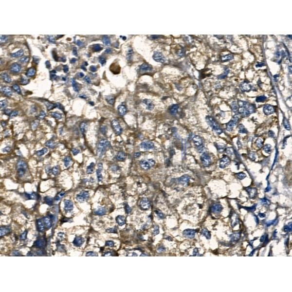 IL12A Antibody - AF5133 at 1/100 staining Human liver cancer by IHC-P.