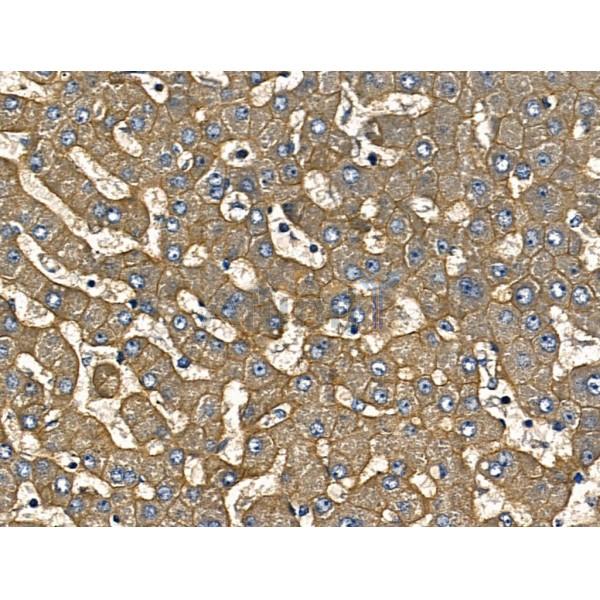 IL12A Antibody - AF5133 at 1/100 staining Human liver cancer and adjacent normal tissues by IHC-P.
