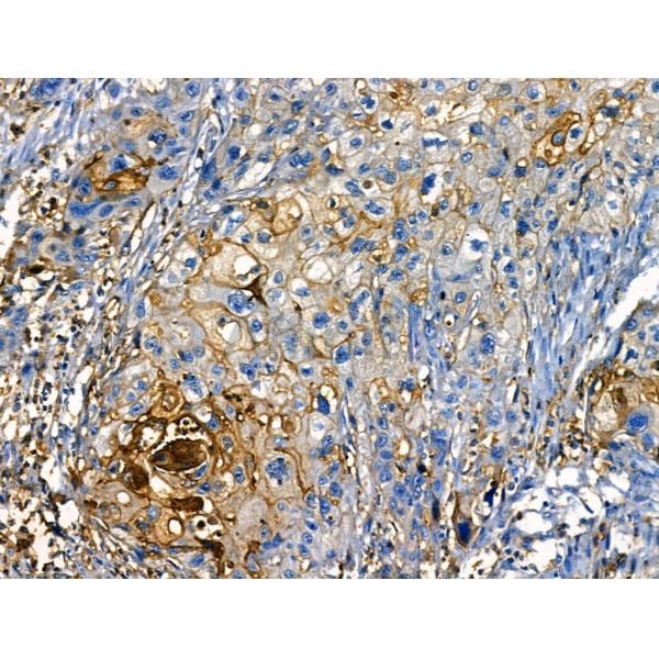 Annexin A1 Antibody - AF5154 at 1/100 staining Human esophageal cancer by IHC-P.