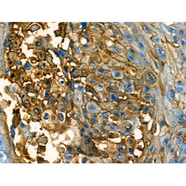 Annexin A1 Antibody - AF5154 at 1/100 staining Human esophageal cancer by IHC-P.
