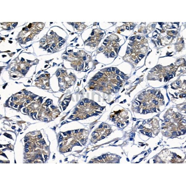 Trefoil factor 2/TFF2 Antibody - AF5157 at 1/100 staining Human gastric cancer and adjacent normal tissues by IHC-P.