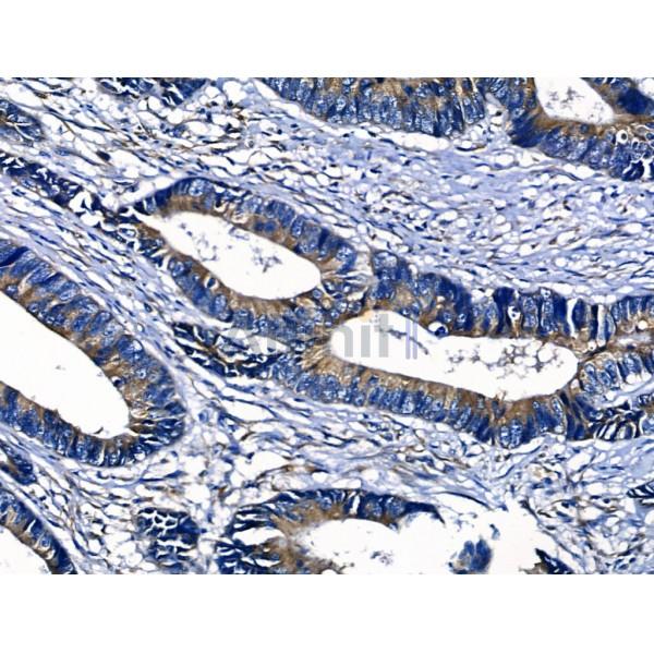 ABCG2 Antibody - AF5177 at 1/100 staining Human colorectal cancer by IHC-P.