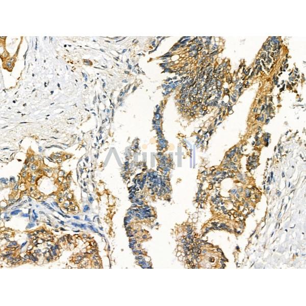 S100A10 Antibody - AF5180 at 1/100 staining Human pancreatic cancer by IHC-P.