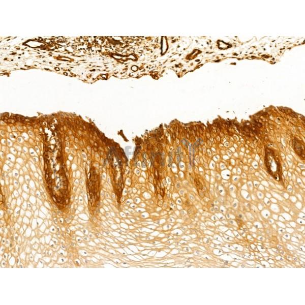 TOMM20 Antibody - AF5206 at 1/100 staining Human esophageal cancer and adjacent normal tissues by IHC-P.