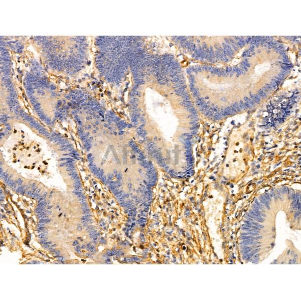 TOMM20 Antibody - AF5206 at 1/100 staining Human colorectal cancer and adjacent normal tissues by IHC-P.