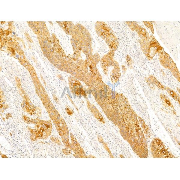 CD147 Antibody - AF5221 at 1/100 staining Human esophageal cancer by IHC-P.