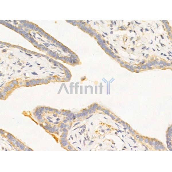 TYK2 Antibody - AF5223 at 1/100 staining Human kidney cancer by IHC-P.