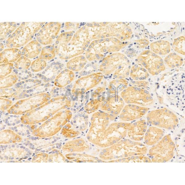 TYK2 Antibody - AF5223 at 1/100 staining Human kidney cancer and adjacent normal tissues by IHC-P.