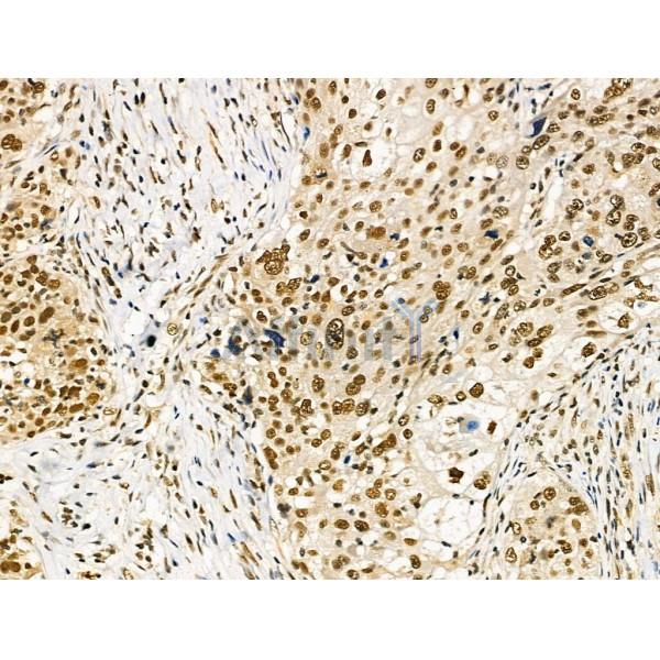 hnRNP H Antibody - AF5241 at 1/100 staining Human ovarian cancer by IHC-P.