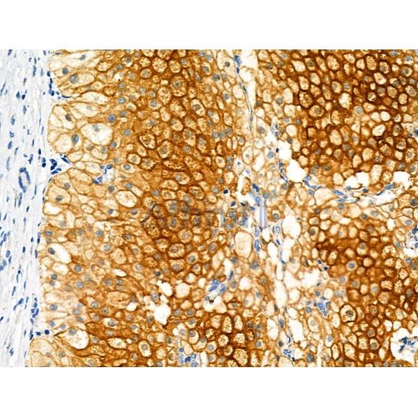 CMKLR1 Antibody - AF5291 at 1/100 staining Human kidney cancer by IHC-P.