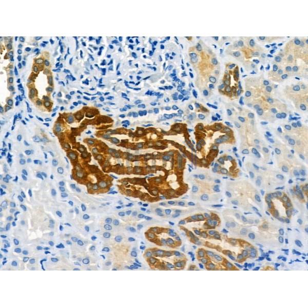 CMKLR1 Antibody - AF5291 at 1/100 staining Human kidney cancer and adjacent normal tissues by IHC-P.