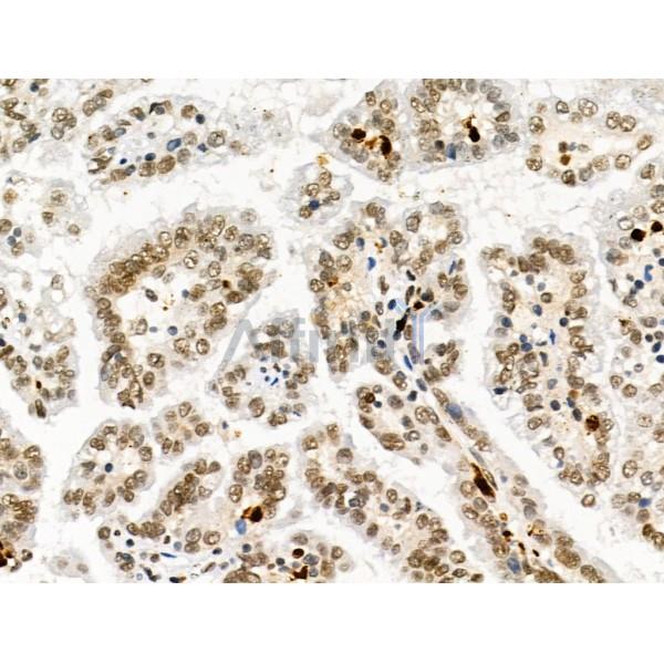 LEG7 Antibody - AF5300 at 1/100 staining Human kidney cancer by IHC-P.