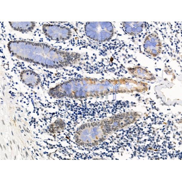 LEG7 Antibody - AF5300 at 1/100 staining Human colorectal cancer and adjacent normal tissues by IHC-P.