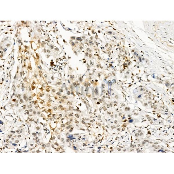 LEG7 Antibody - AF5300 at 1/100 staining Human pancreatic cancer by IHC-P.