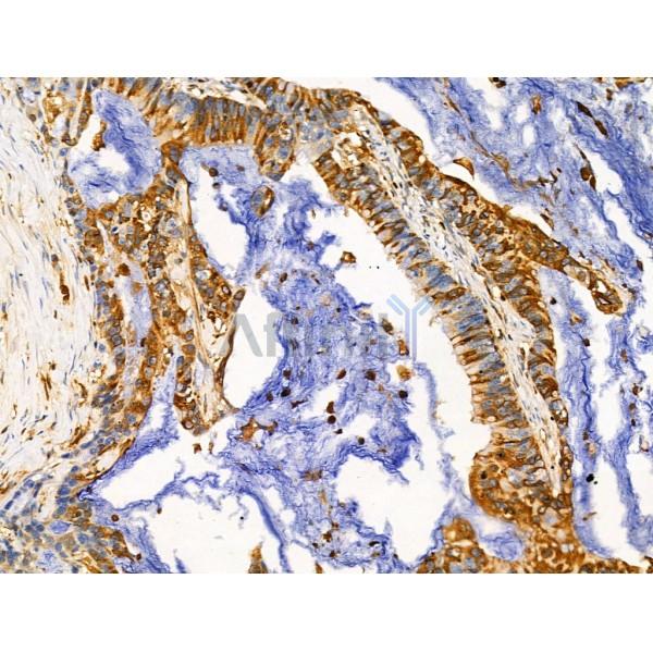 S100A4 Antibody - AF5320 at 1/100 staining Human colorectal cancer by IHC-P.