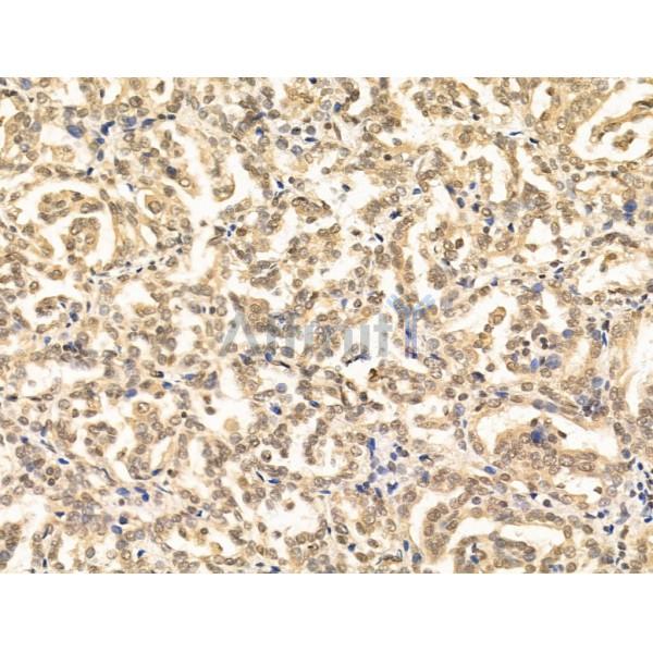 AP2 alpha Antibody - AF5323 at 1/100 staining Human esophageal cancer by IHC-P.