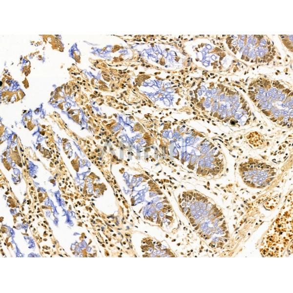 AP2 alpha Antibody - AF5323 at 1/100 staining Human gastric cancer and adjacent normal tissues by IHC-P.