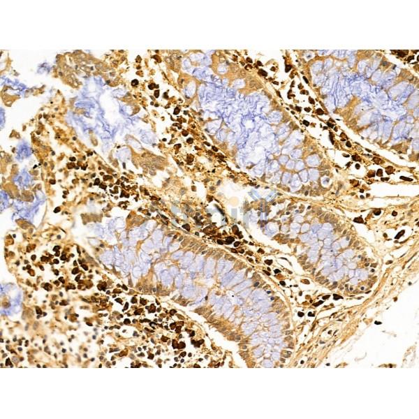 Gastrin Antibody - AF5352 at 1/100 staining Human gastric cancer and adjacent normal tissues by IHC-P.