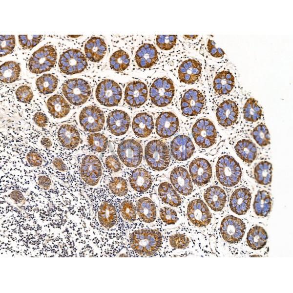 COX IV Antibody - AF5468 at 1/100 staining Human colorectal cancer and adjacent normal tissues by IHC-P.