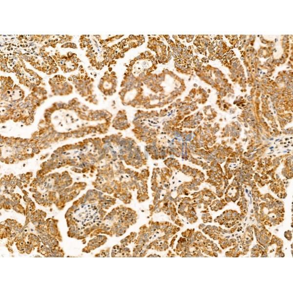 COX IV Antibody - AF5468 at 1/100 staining Human kidney cancer by IHC-P.