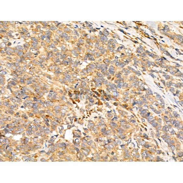 Estrogen Sulfotransferase Antibody - DF12137 at 1/100 staining Human mammary cancer by IHC-P.