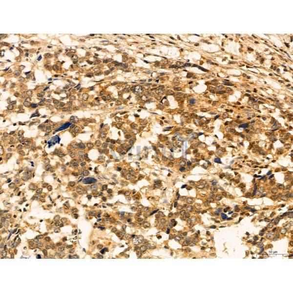 ADRM1 Antibody - DF12142 at 1/100 staining Human gastric cancer by IHC-P.
